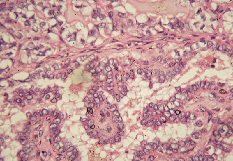 thyroid-cancer-under-microscope
